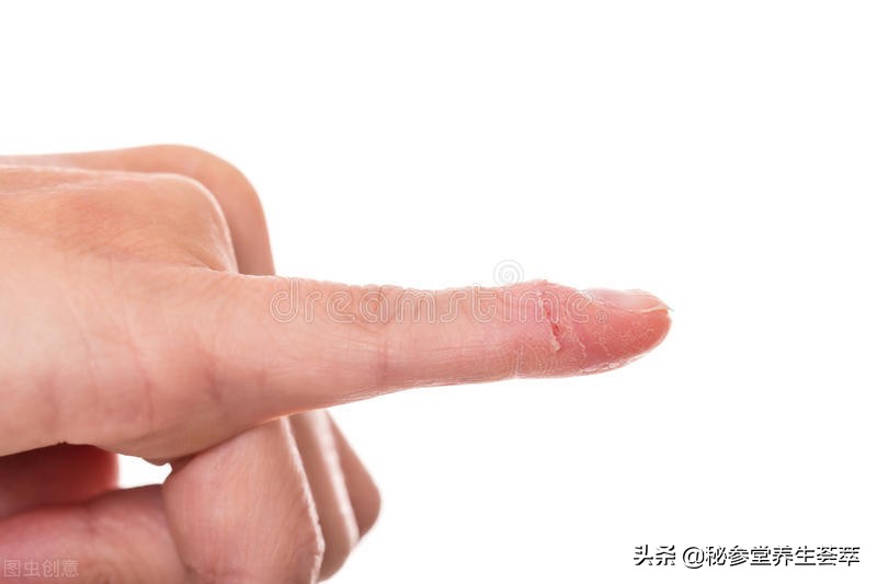 严重甲沟炎排脓放血,甲沟炎自行切开排脓