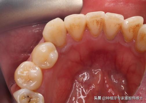 全冠修复与种植区别,全口即刻种植修复详细流程介绍