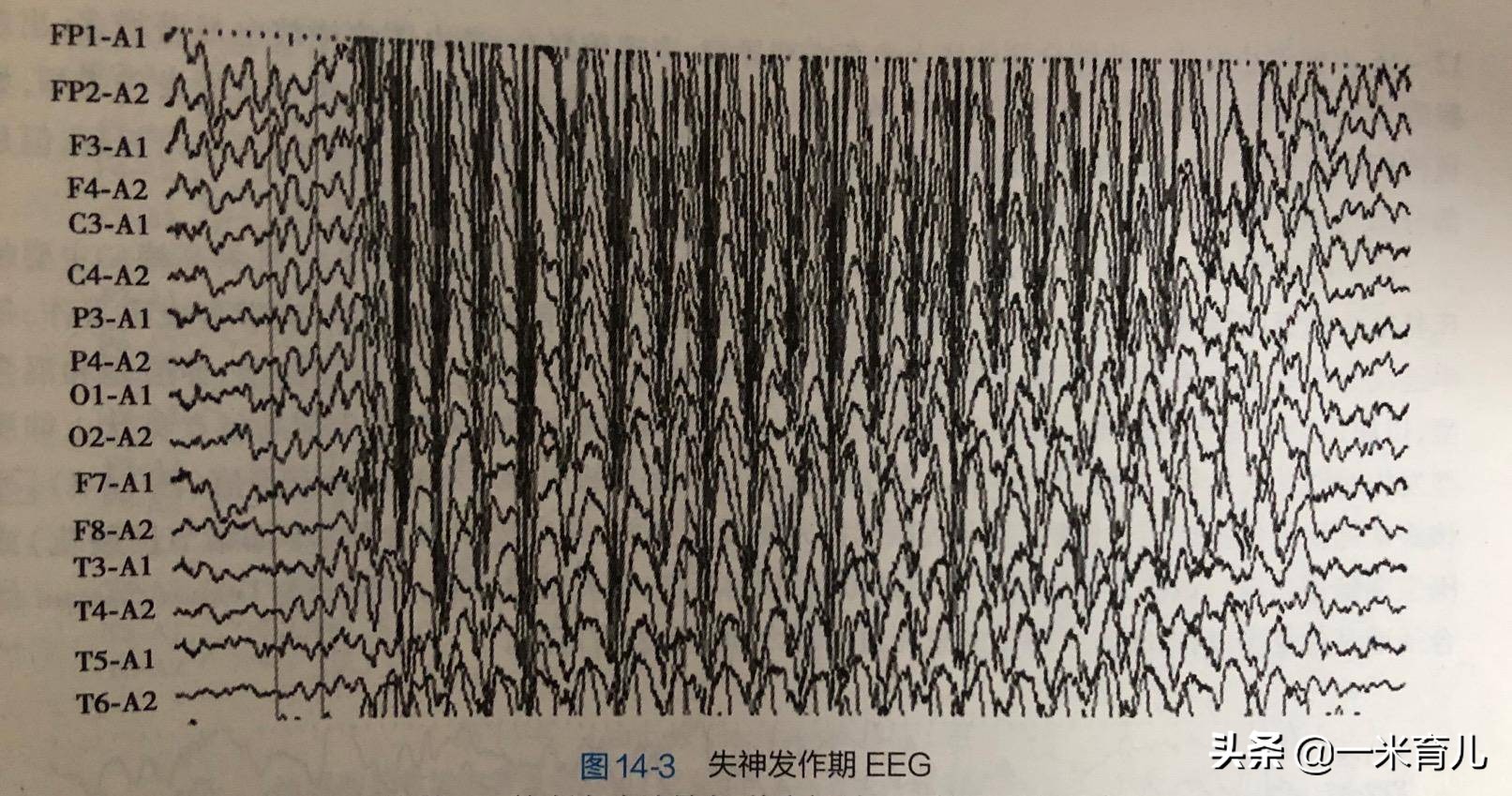 小儿癫痫莫要怕，规律服药、做好居家护理8要点，成长上学两不误