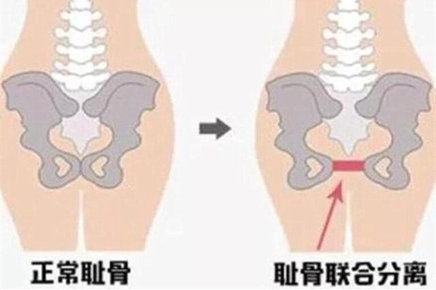 孕妇耻骨痛是什么原因引起,孕妇耻骨痛突然减轻了怎么回事