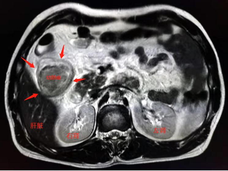 肚子老是咕噜咕噜响是肠癌表现吗,肚子咕噜咕噜响胀气是怎么回事