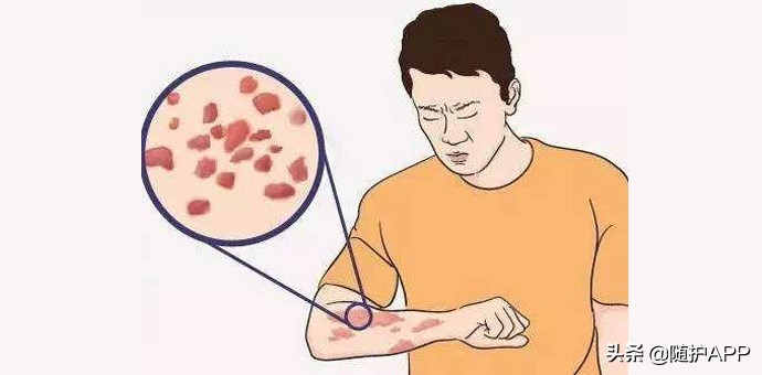 hiv的小红疹长什么样,hiv的小红点是病毒疹吗