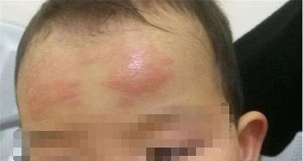 儿童退热贴骗局揭秘,用退热贴真的好吗