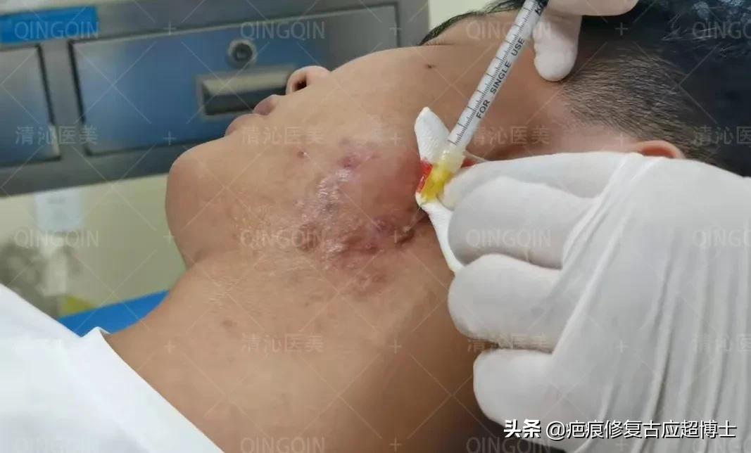 瘢痕疙瘩手术加放疗复发几率,瘢痕疙瘩手术百分百复发吗