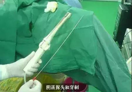 那些二十几岁卖卵的姑娘后来怎么样了，绝经，不孕，早衰or?