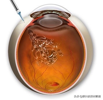 关于糖尿病视网膜病变的20个问题,22岁糖尿病人的真实经历