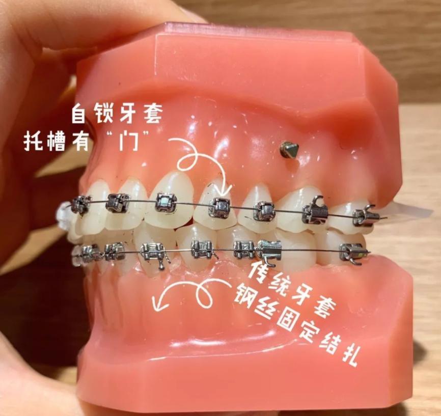 为啥进行牙齿矫正价钱不一样,最好的牙齿矫正需要多少钱