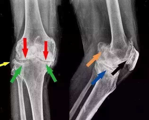 颈椎腰椎骨刺怎么治才能彻底根除,腰椎和颈椎骨刺的治疗方法