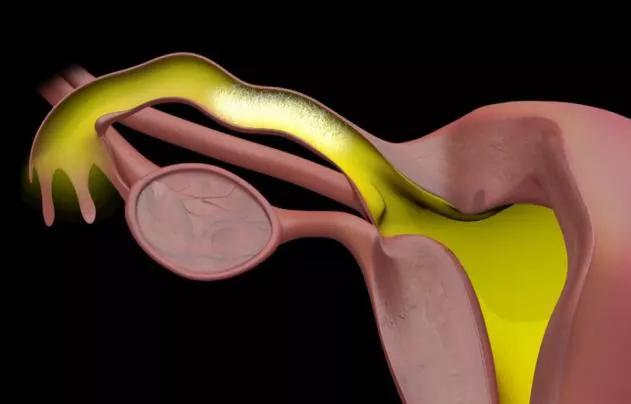 特色诊疗：无痛动态子宫输卵管造影