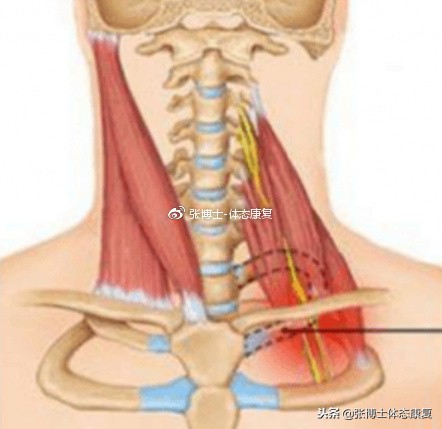 「体态矫正」手臂麻木疼痛，可能与第一肋骨上提移位有关