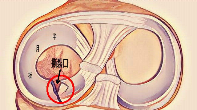 半月板撕裂要不要去修复,内侧半月板撕裂会切除多少半月板