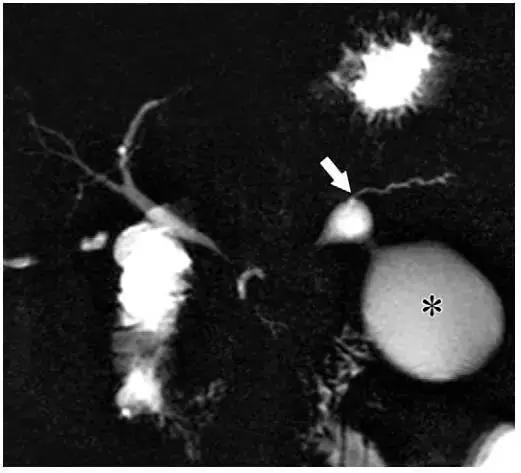 简述急性胰腺炎影像学表现,有关急性胰腺炎疼痛的图片
