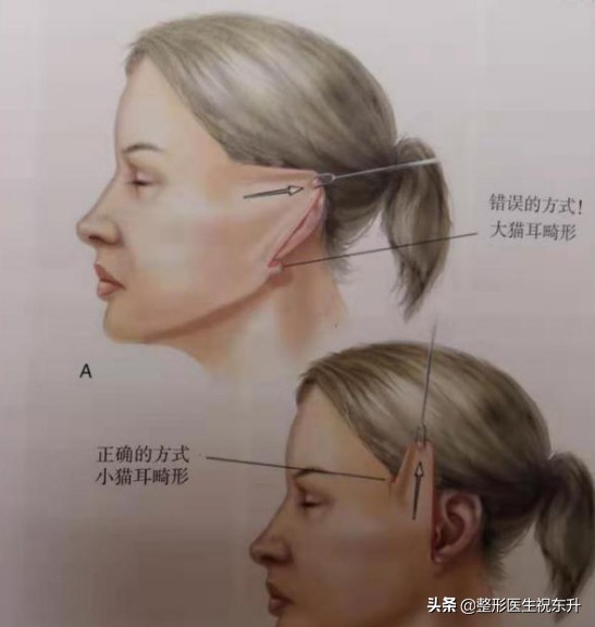 大拉皮手术失败,大拉皮手术后不流行