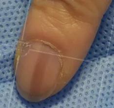 美甲会不会导致灰指甲,灰指甲脱甲液致癌