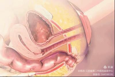 直肠癌术后排便能恢复一天一次吗,直肠癌术后排便不顺畅如何解决