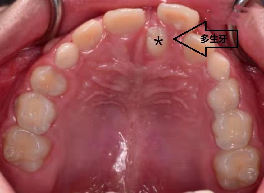 小孩大门牙中间有缝,男人门牙中间有缝面相
