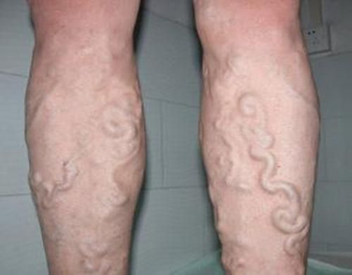 小腿肚酸胀是缺钙吗,小腿酸胀与静脉曲张有关系吗