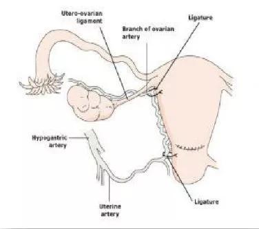 产后出血纱布填塞取出步骤,产后出血放置球囊操作记录
