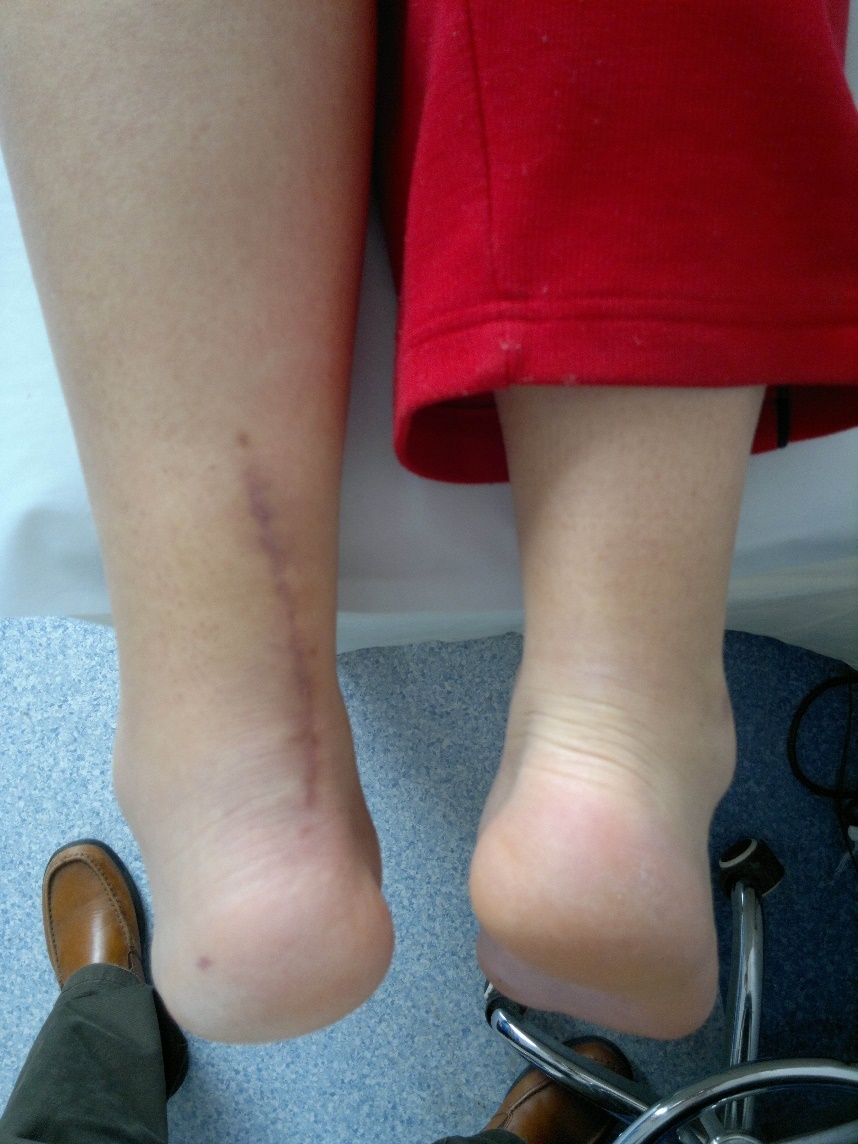 陈旧性跟腱断裂手术后恢复效果,陈旧性跟腱断裂表现