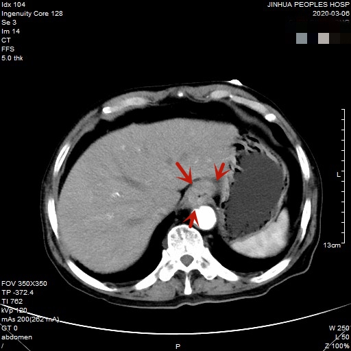 贲门癌80岁手术好还是保守治疗好,医生建议80岁老人做贲门癌手术