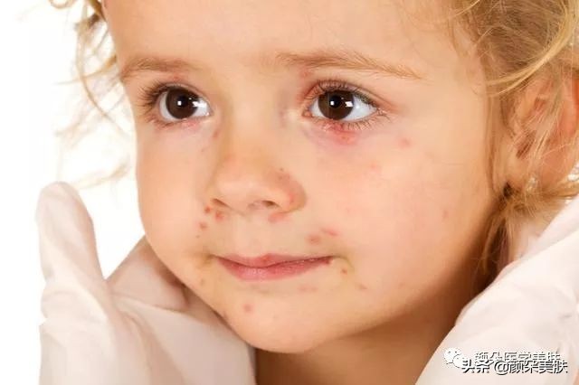 脸颊长痘痘是身体哪个部位出问题,脸上长痘痘是身体哪个部位的原因