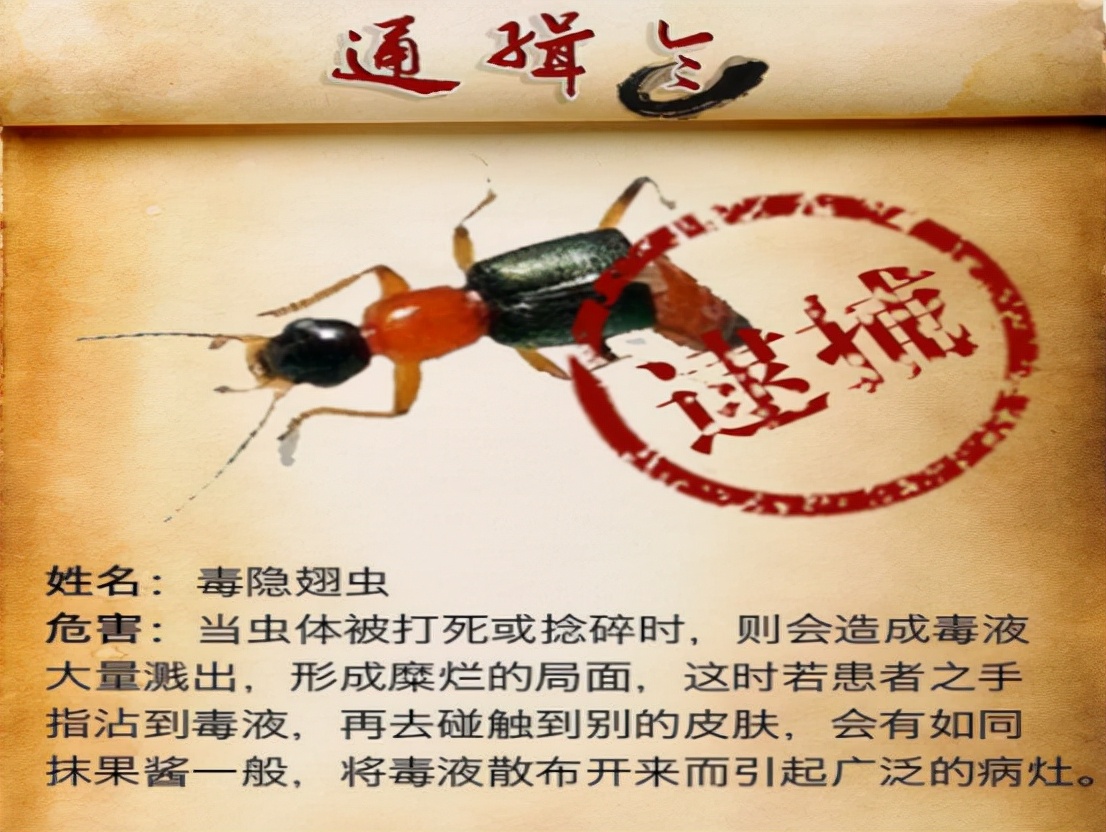 被隐翅虫咬伤有多可怕,被隐翅虫咬后症状图片及治疗方法