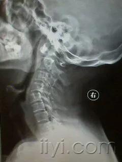 颈椎腰腿痛治疗手法,老中医治疗颈椎腰腿疼