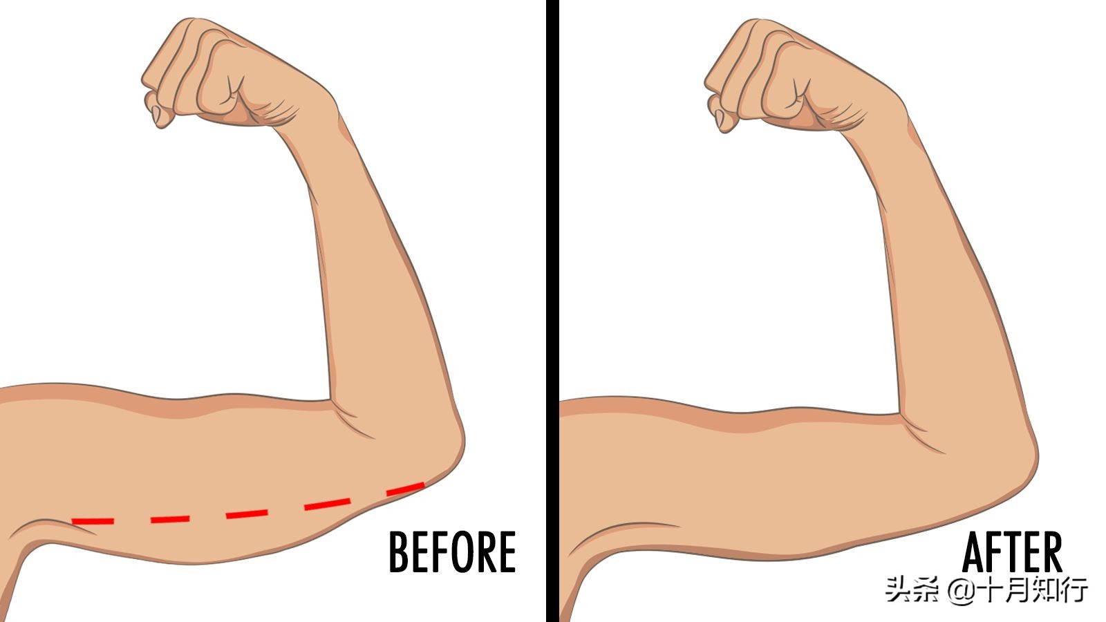 手臂松弛显胖又显老,手臂松弛显老怎么办