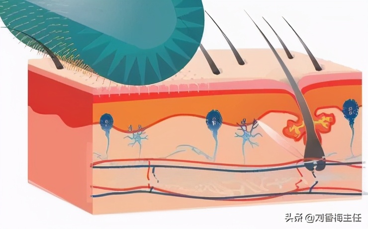 痘印痘坑对颜值的影响,严重的痘坑护肤可以修复吗