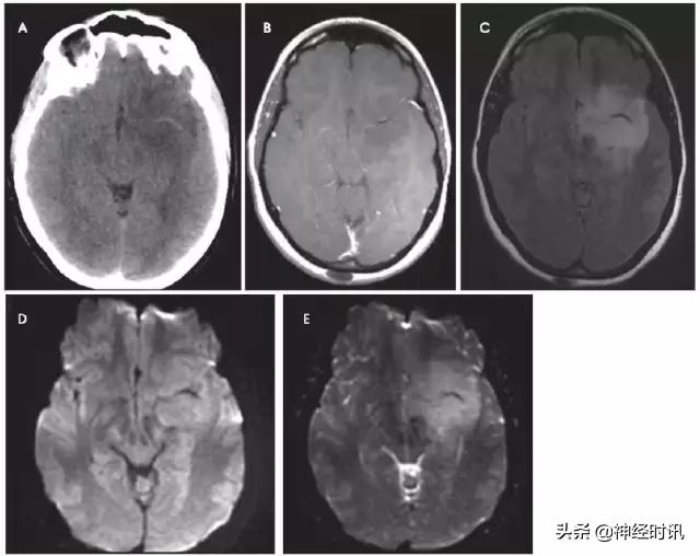 脑卒中的快速识别ppt,脑卒中神经影像学实例解析