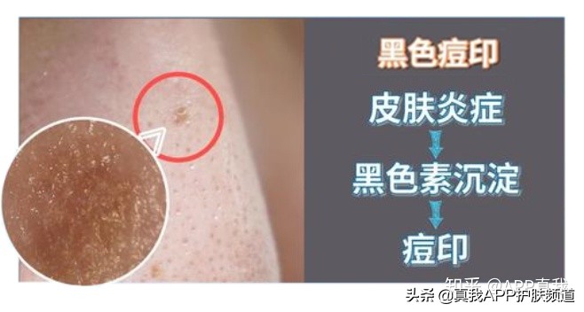 挤痘痘留下痘印多久会好,挤痘痘有哪些危害