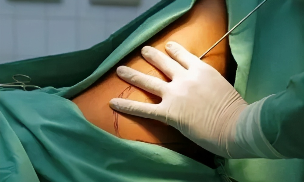 吸脂后出现淤青，应该如何应对？