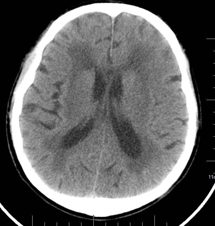 脑梗溶栓后脑出血脑疝晚期,阿替普酶溶栓后脑出血处理