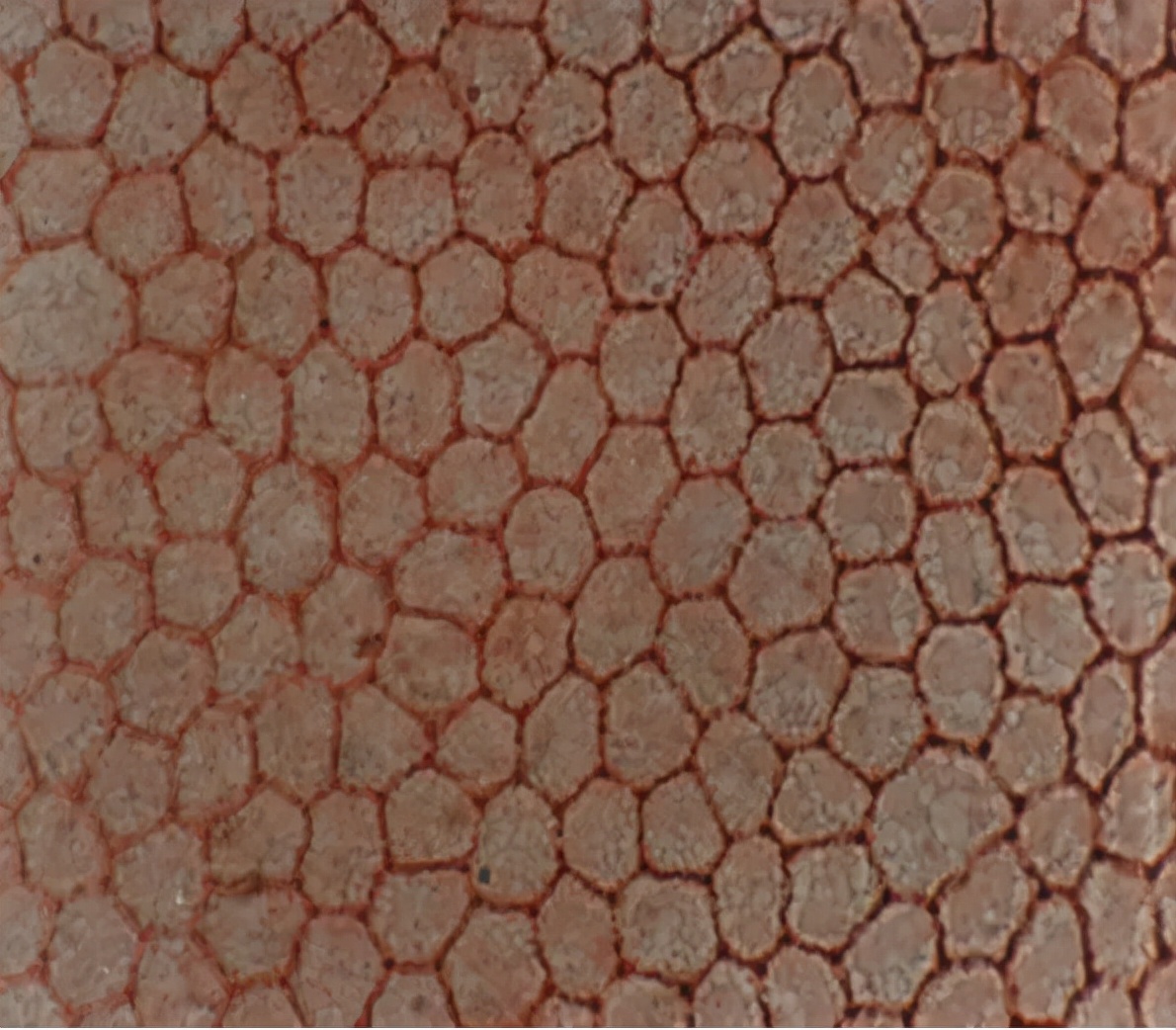 「学术交流」超声乳化手术与角膜内皮细胞保护