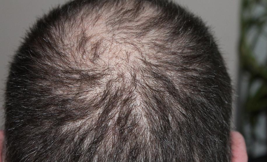 脱发治疗首先要防脱,脱发防脱四大技巧