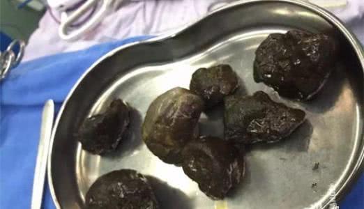 柿子可不可以和牛奶一块吃,柿子能和牛奶一起吃吗会结石吗