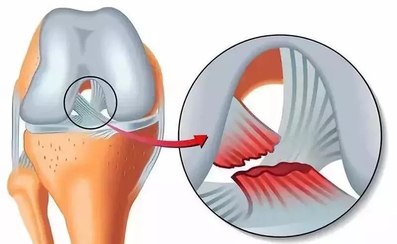 足球常见伤,足球中常见的运动损伤处理