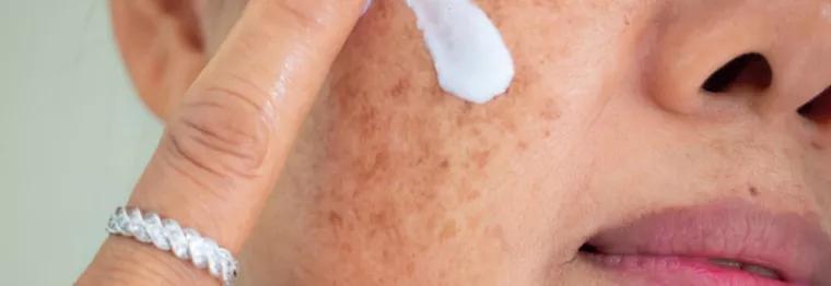 褐斑怎么治疗最有效,褐斑怎么治才能除根