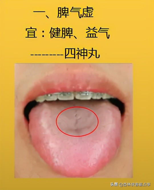 生理性齿痕舌与病理性齿痕舌,齿痕舌形成的原因是脾虚还是瘀血