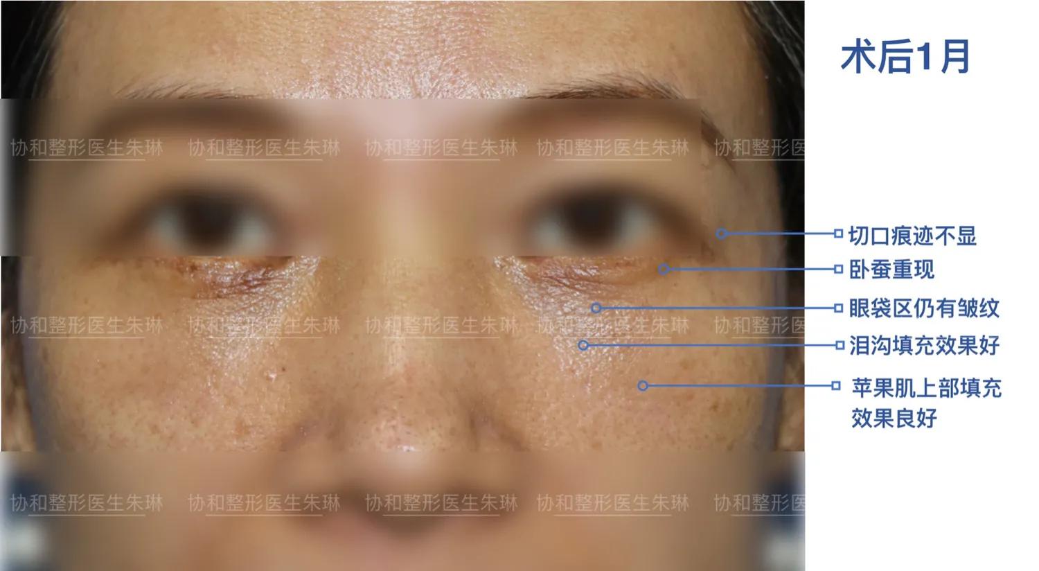 外切眼袋消肿食谱,外切眼袋20天效果图