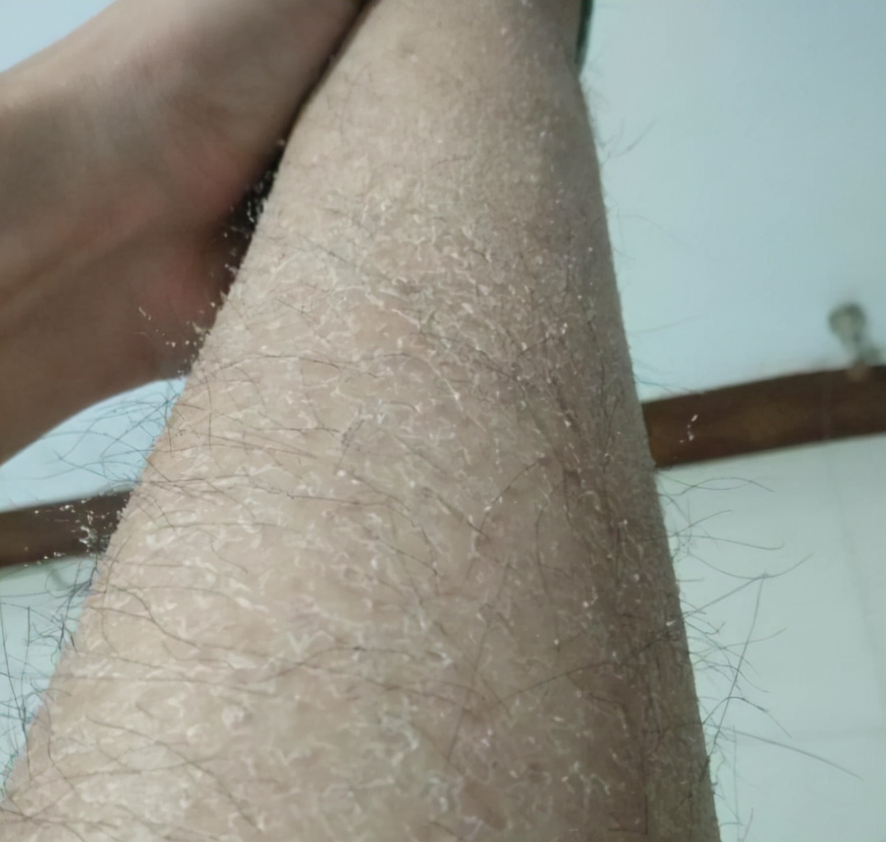 一到冬天脱了裤子腿就特别痒,冬天裤子一脱里面全是皮屑