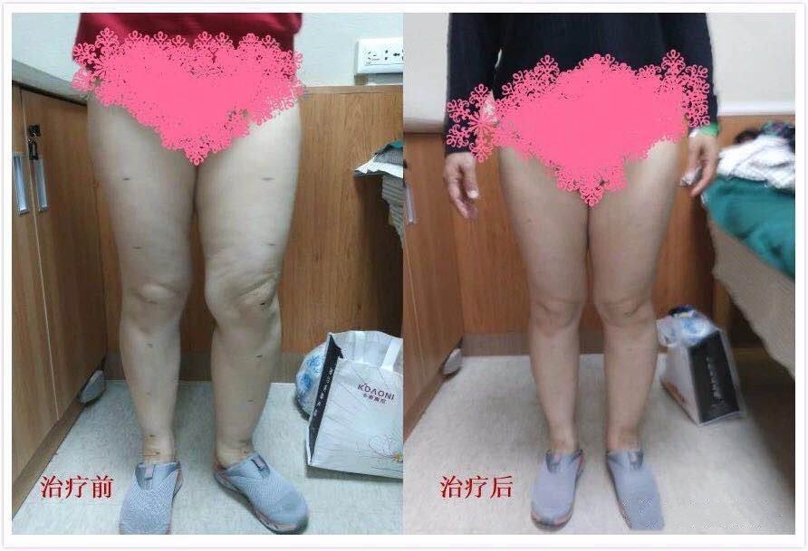 确诊宫颈癌最可靠的方法,宫颈癌病友治愈自述