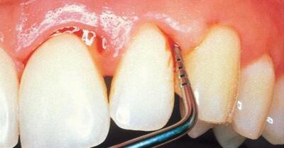 牙龈萎缩龈下刮治后萎缩更严重,牙槽骨萎缩和牙龈萎缩是一回事吗