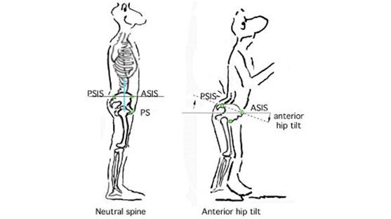 硬拉弓背矫正,硬拉弓背是什么原因