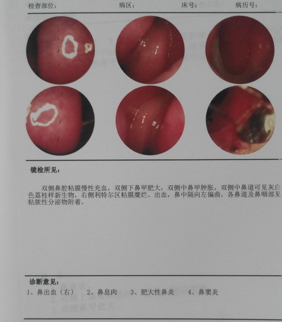 鼻窦炎患者做鼻内窥镜的经验介绍,鼻窦炎鼻息肉术后易复发吗