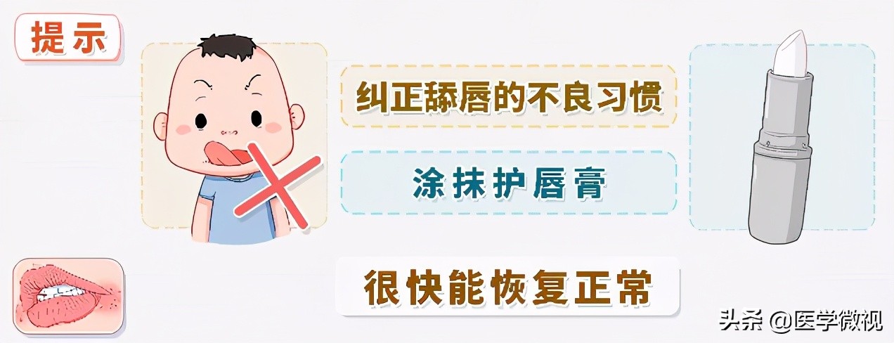 得了嘴角炎怎么办,经常烂嘴角吃什么药好得快