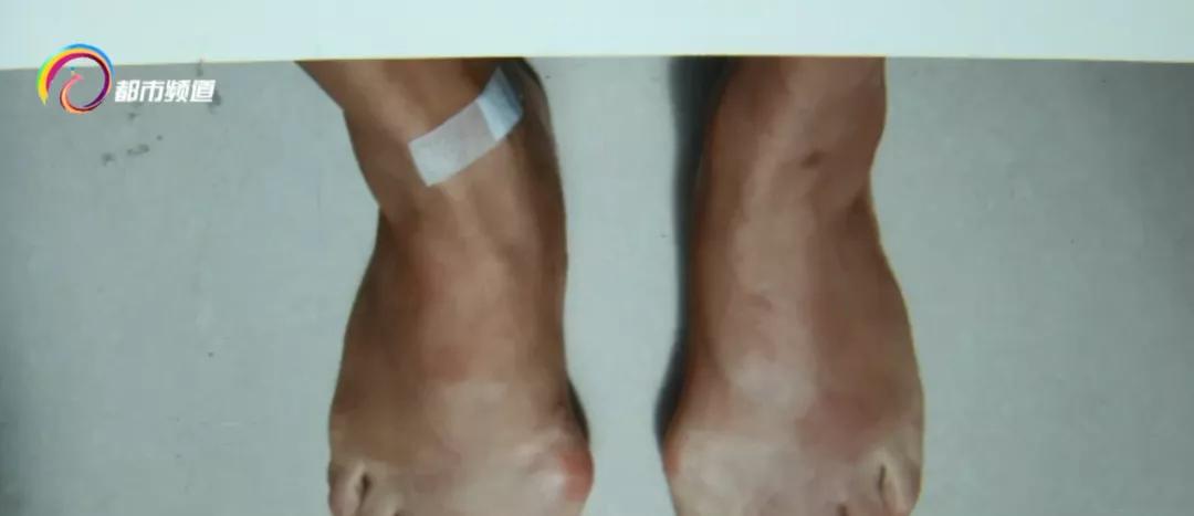 脚被红火蚁叮咬后红肿严重,被红火蚁叮咬了会出现什么症状