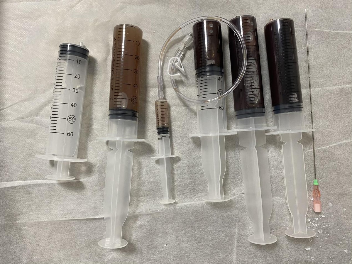 卵巢畸胎瘤和巧克力囊肿,未婚女性卵巢巧克力囊肿