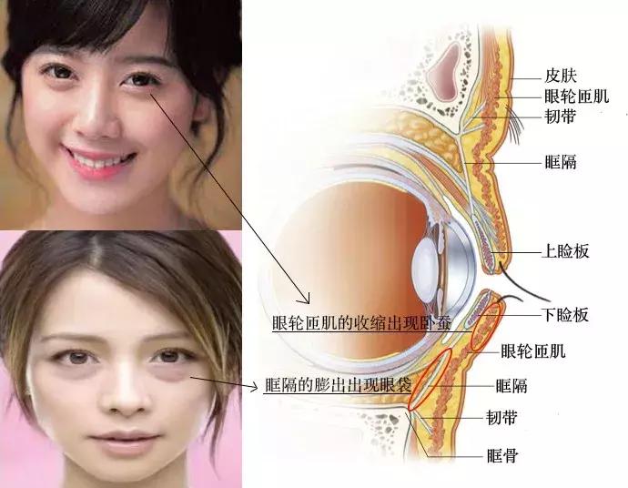 去眼袋要卧蚕两种技能全get,去眼袋需要什么条件