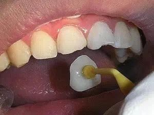 牙缝大该怎么补救,剔牙造成牙缝大怎么补救